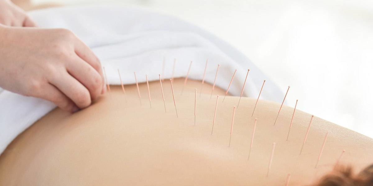 an example of acupuncture for addiction