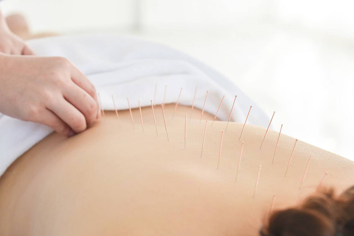 an example of acupuncture for addiction